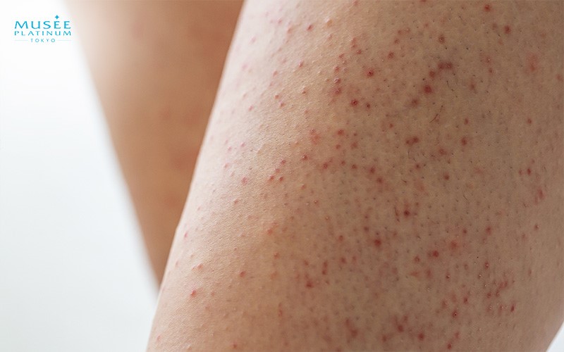A L:ady With Hairless Legs After MIT Radiance Treatment